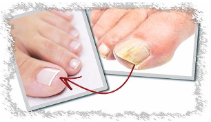 Causes of toenail fungus