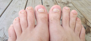 Nail fungus on the feet