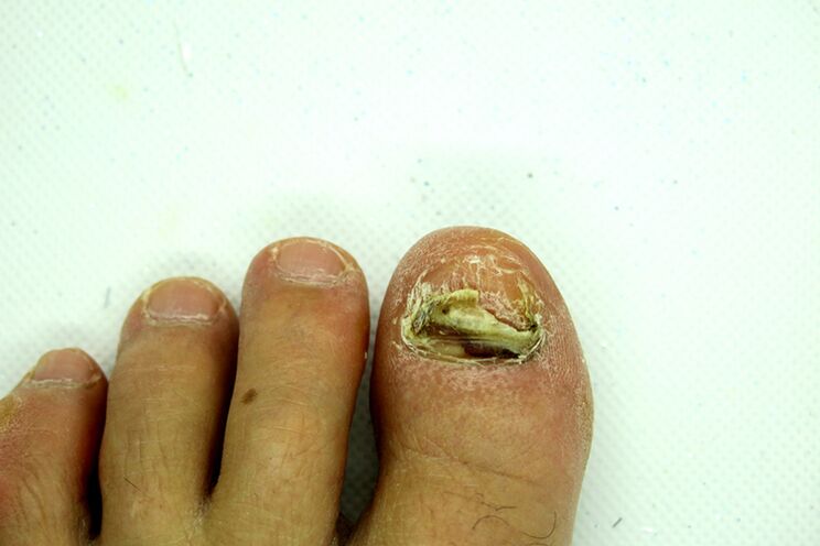 Toenail fungus - severe stage