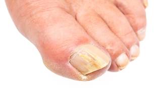 what is the nail fungus is