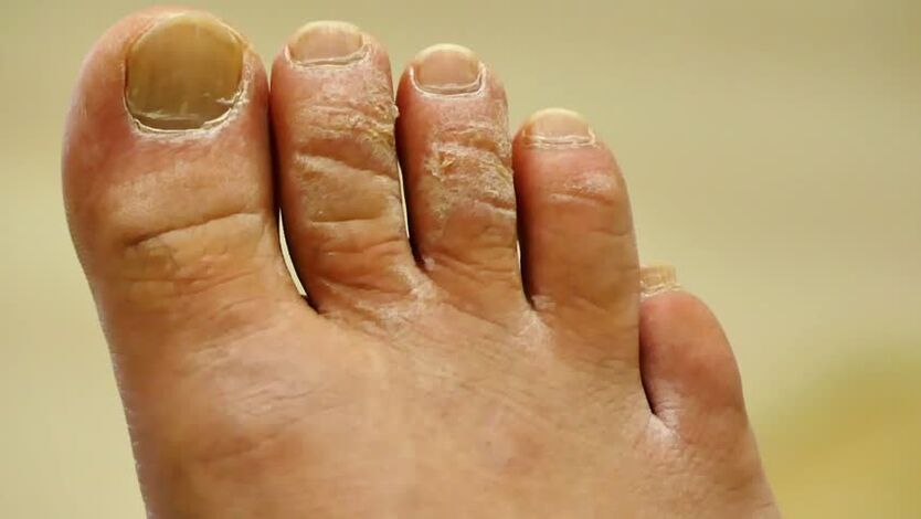 Squamous cell toenail fungus