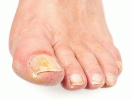 Damage to the nails with fungus on the feet