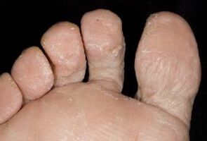 Fungal symptoms on the skin of the feet