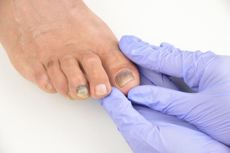 Medical examination of toenails affected by a fungus