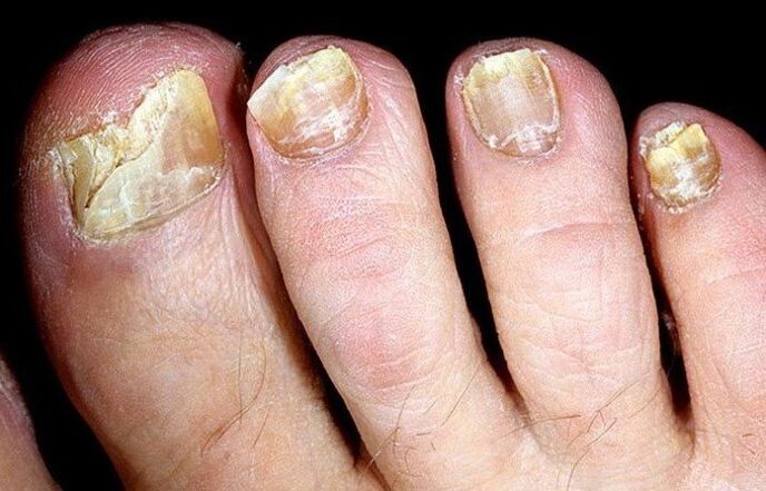 Fungus on toenails