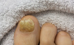 Nail fungus