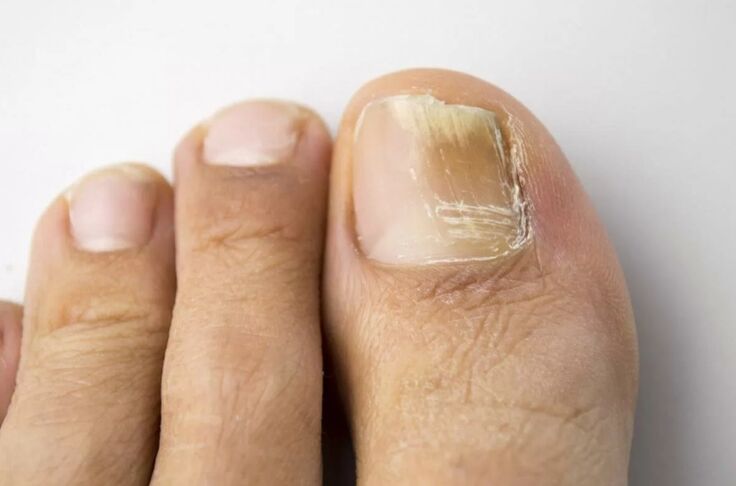 Mycosis of the nail on the leg