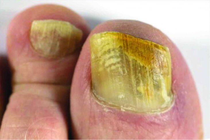 Nail feeling on the leg