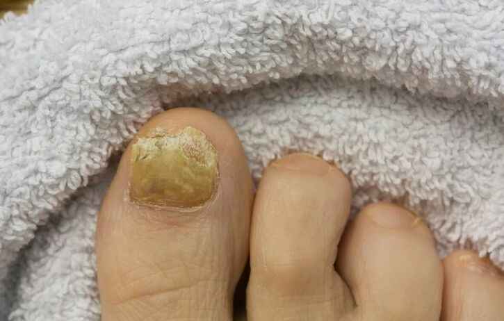 Nail fungus