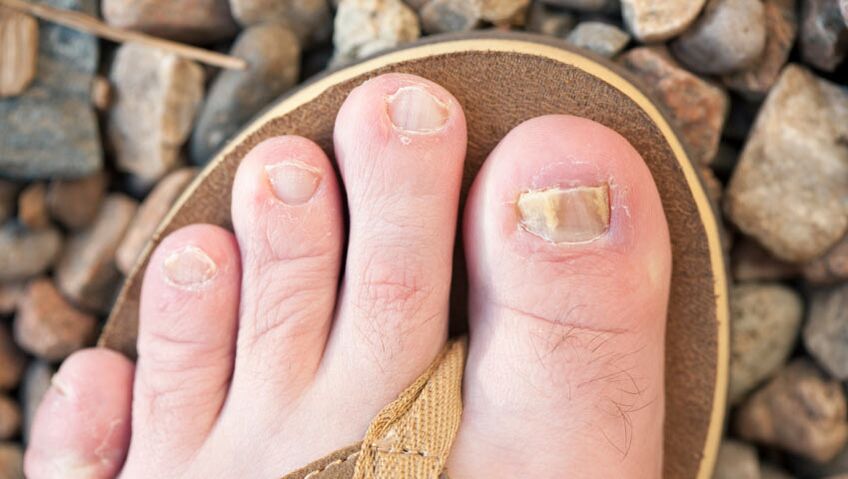 Onychomycosis of the nails